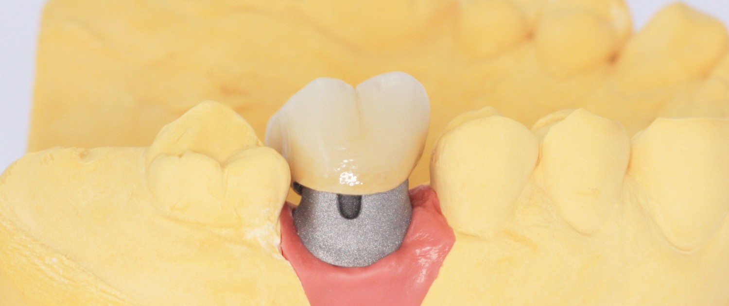 Der künstliche Zahnstumpf nach menschlichem Vorbild