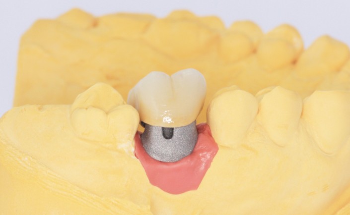 Der künstliche Zahnstumpf nach menschlichem Vorbild